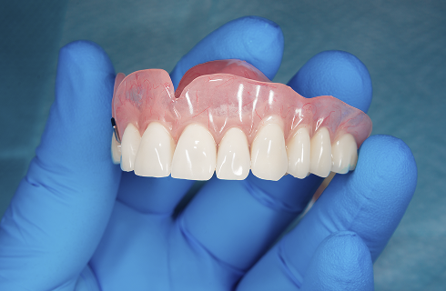 laboratoire dentaire implant dentaire metz Prothèse adjointe numérique label-dent