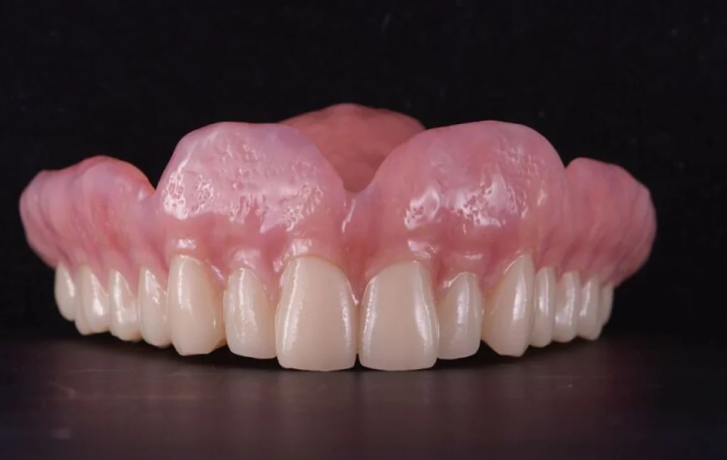 laboratoire dentaire prothese numerique precision Prothèse adjointe numérique label-dent