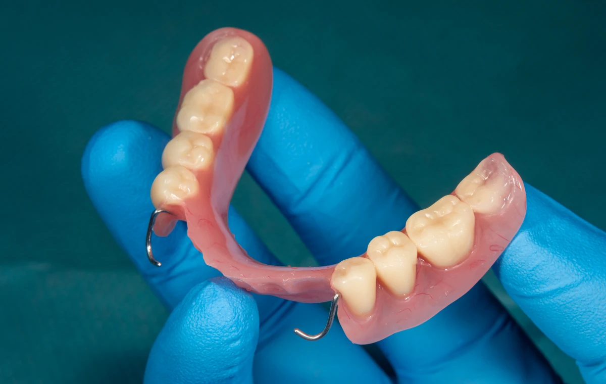 prothese adjointe numerique conception cad cam KIZUNA Sophie Dallem & George Zacusai label-dent