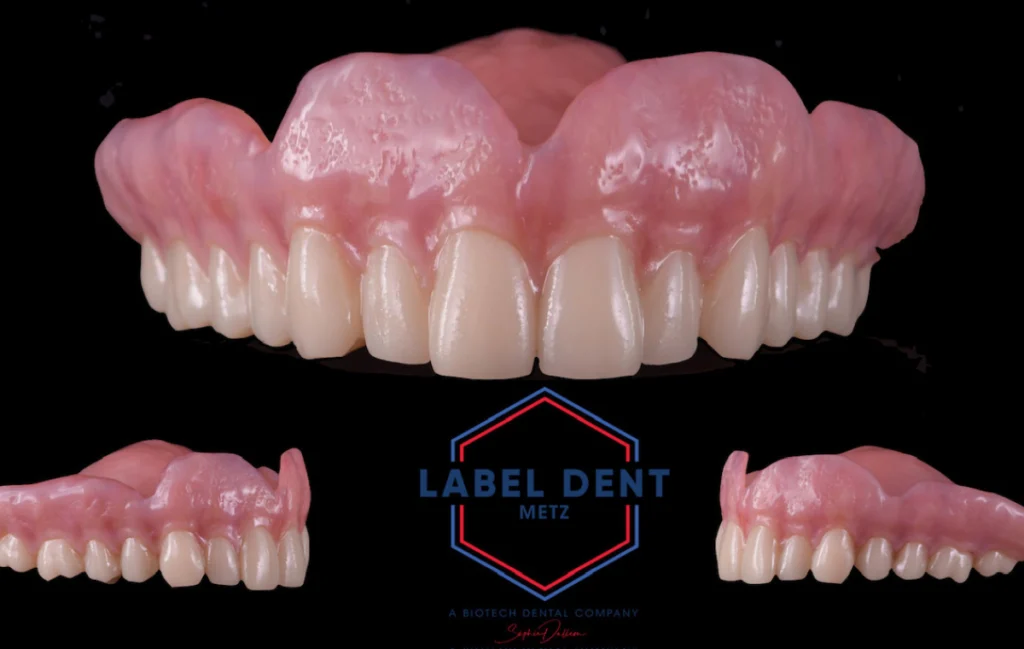 prothese conjointe numerique conception avancee Prothèse adjointe numérique label-dent