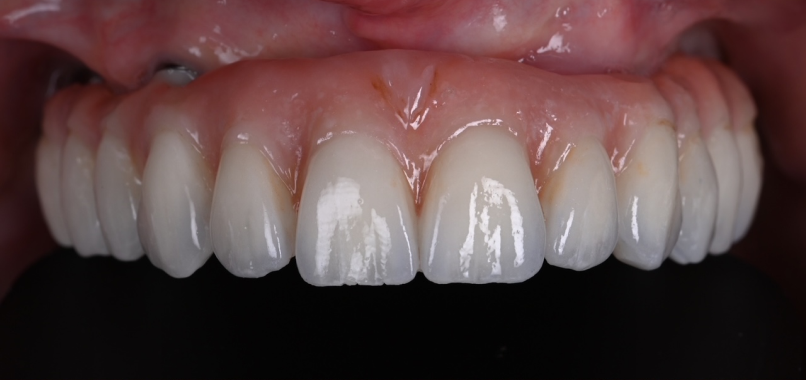 cire dentaire modelage prothetique Nos réalisations label-dent