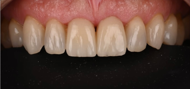 dentisterie esthetique flux numerique dentaire Nos réalisations label-dent