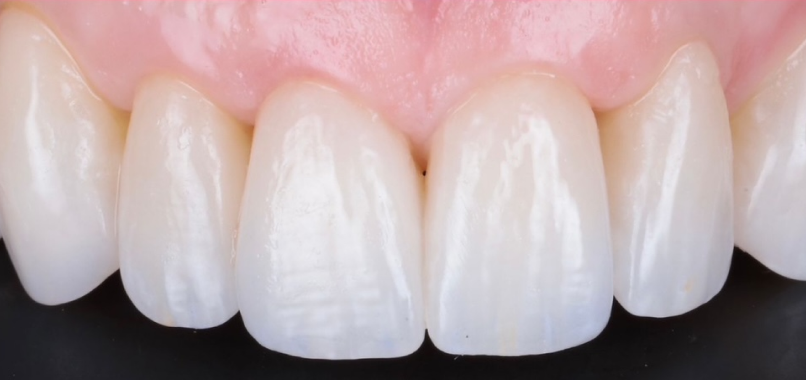 dentisterie esthetique prothese haute precision Nos réalisations label-dent