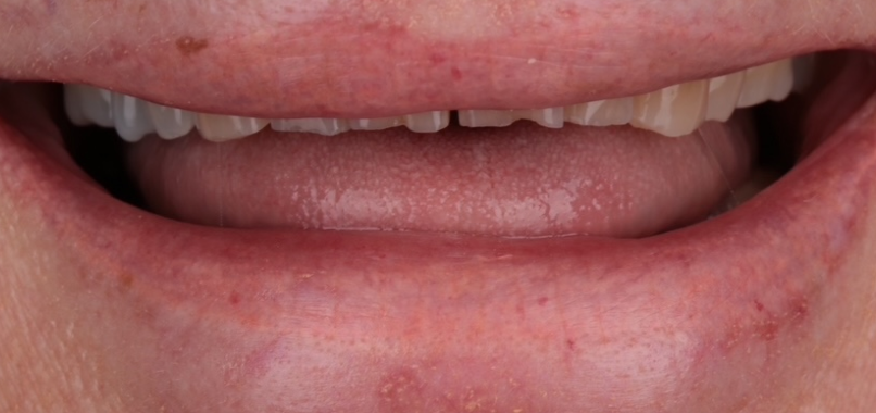 dentisterie esthetique restauration prothetique moderne Nos réalisations label-dent