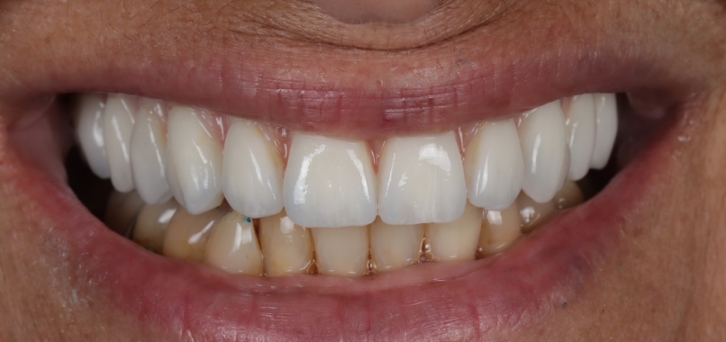 desilicate lithium prothese esthetique durable Nos réalisations label-dent