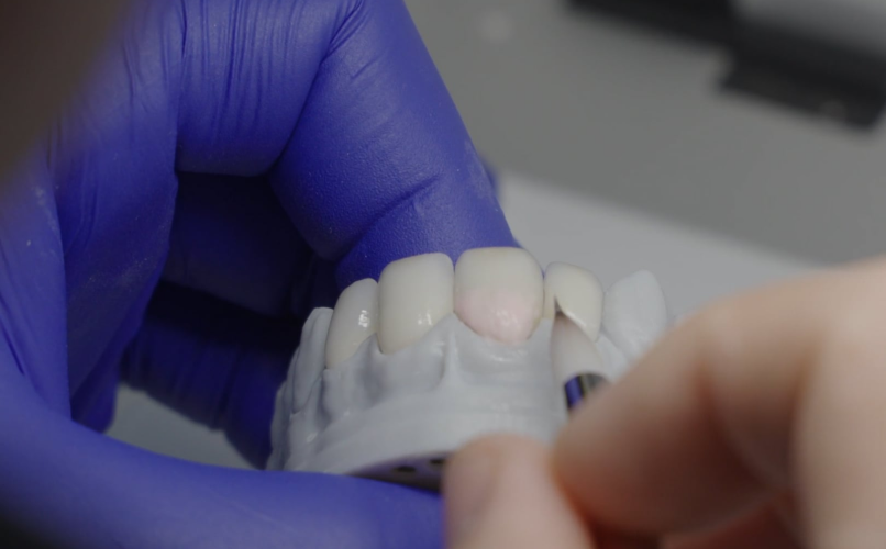 prothese conjointe restauration esthetique durable Formation Mariano Maurigi label-dent