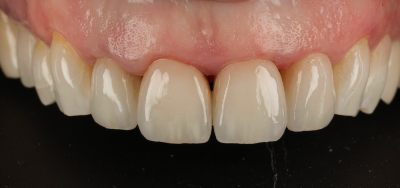 prothese dentaire flux numerique avance Nos réalisations label-dent